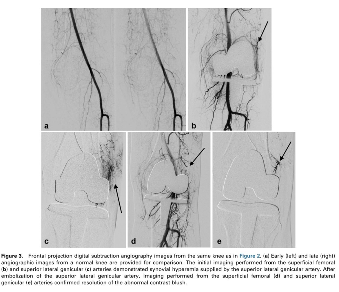 Latest in <a href="/JVIRmedia/">JVIR</a> 

“Targeted genicular artery embolization with spherical embolics is an effective treatment for recurrent hemarthrosis with infrequent serious complications. Repeat embolization should be considered in cases of recurrence following initial therapy.”