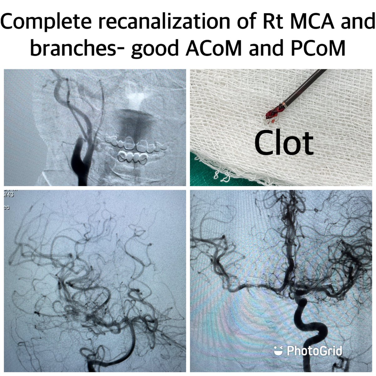 dr_phuyal's tweet photo. Neurointervention- Nepal:
Sharing you all my first experience with bilateral MCA occlusions in 45y/F, 3hrs onset: successful recanalization with timely mechanical thrombectomy ( Lt -#AC68; Rt- #solumbra) @PenNeuro
#interventionalradiologynepal
#strokeawareness https://t.co/11QJjvfRgQ