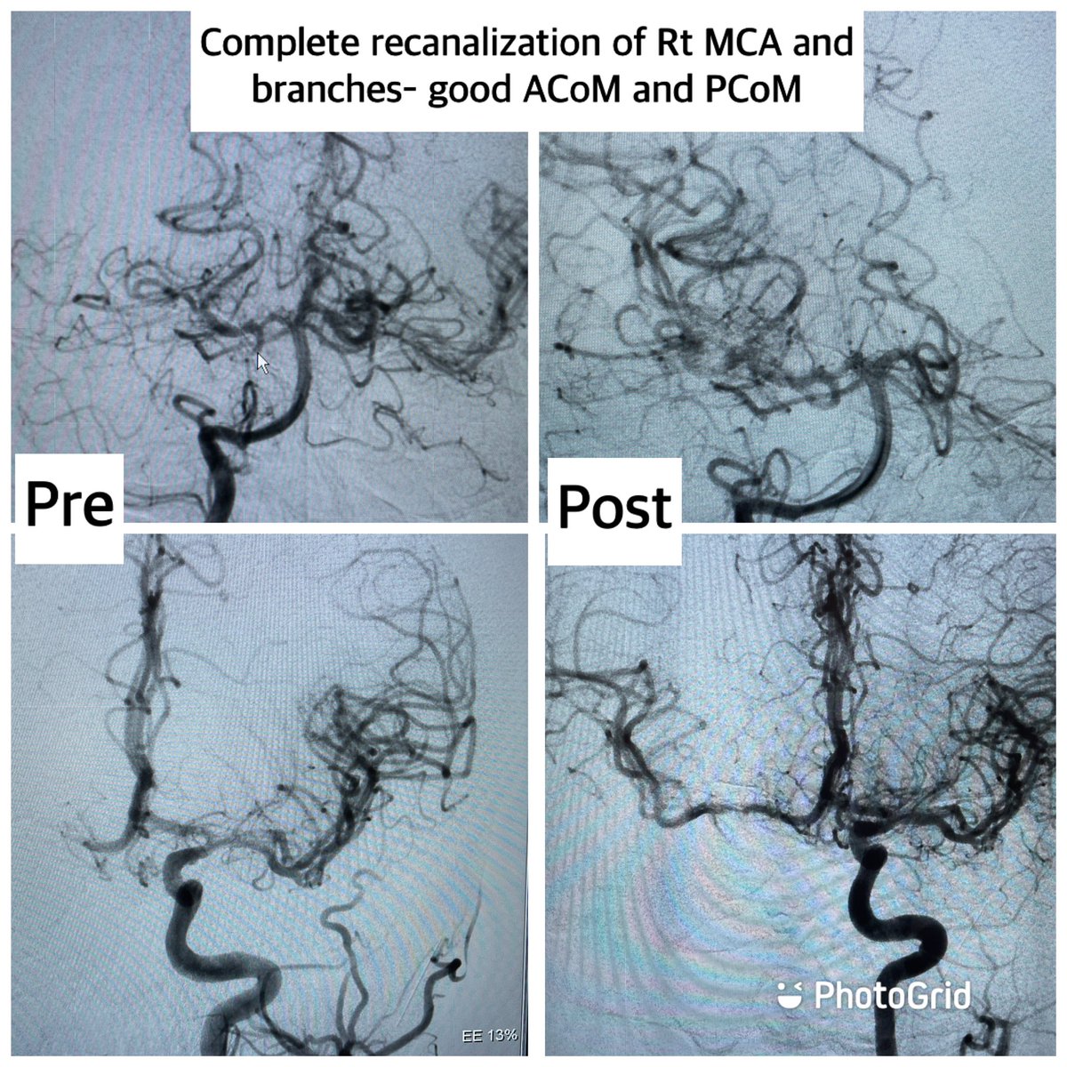 dr_phuyal's tweet photo. Neurointervention- Nepal:
Sharing you all my first experience with bilateral MCA occlusions in 45y/F, 3hrs onset: successful recanalization with timely mechanical thrombectomy ( Lt -#AC68; Rt- #solumbra) @PenNeuro
#interventionalradiologynepal
#strokeawareness https://t.co/11QJjvfRgQ