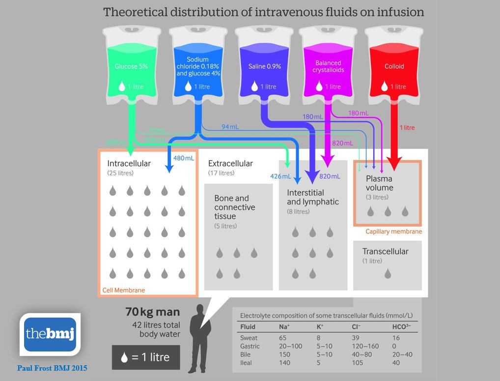 Body fluid compartment volumes and theoretical distribution of intravenous fluids in healthy people.
#MedEd #Criticalcare #Nephrology 
bmj.com/content/350/bm…