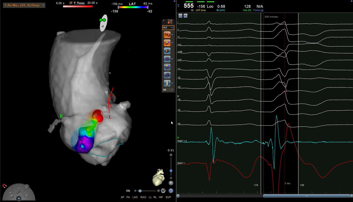 Ivo Roca, FEHRA, FESC (@ivroca) on Twitter photo Mapping is important but ECG and ANATOMY are always the key in PVC ablation. ECG suggested interleaflet right-left cusp. Left main with RF catheter for merging with CT. Go to the target area according ECG and that’s it! <a href="/hospitalclinic/">Hospital Clínic</a> <a href="/FAlarcon14/">Fran Alarcon</a> <a href="/galacavi/">Gala Caixal</a> <a href="/DrFerminGarcia/">Fermin Carlos Garcia</a> Mapping is important but ECG and ANATOMY are always the key in PVC ablation. ECG suggested interleaflet right-left cusp. Left main with RF catheter for merging with CT. Go to the target area according ECG and that’s it! <a href="/hospitalclinic/">Hospital Clínic</a> <a href="/FAlarcon14/">Fran Alarcon</a> <a href="/galacavi/">Gala Caixal</a> <a href="/DrFerminGarcia/">Fermin Carlos Garcia</a>