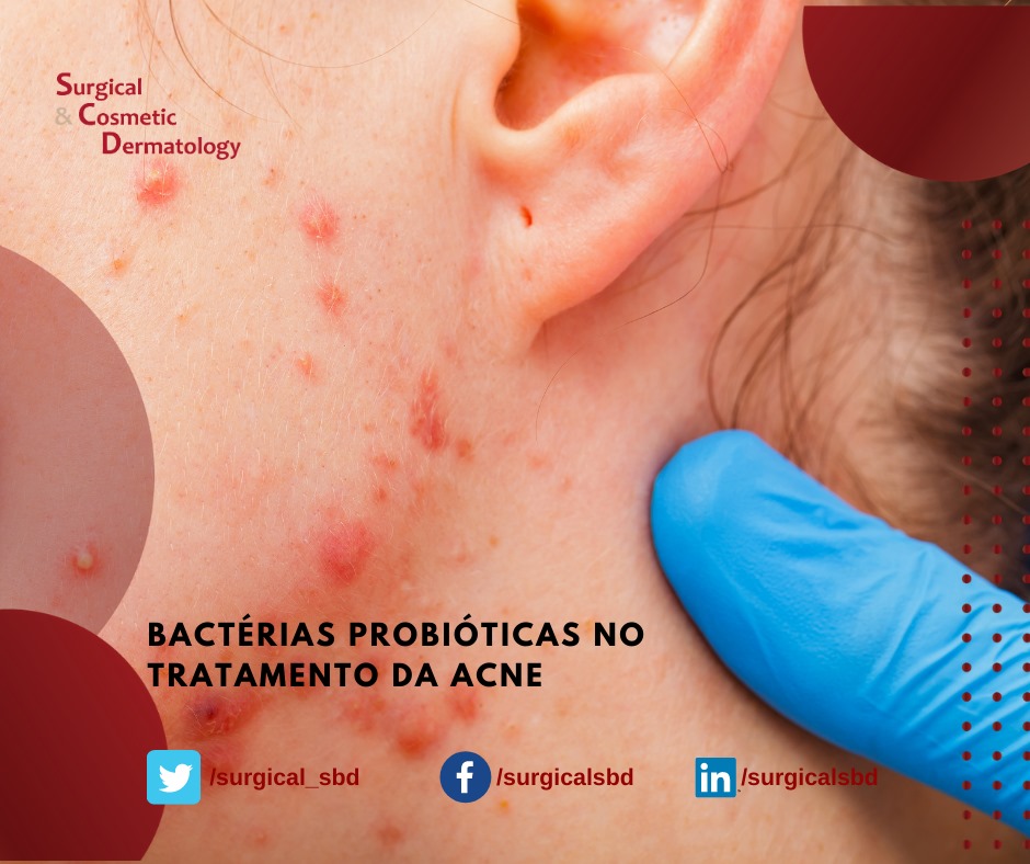 surgical_sbd's tweet photo. Por terem efeito anti-inflamatório, as bactérias probióticas têm sido usadas como opção de tratamento da acne de forma oral e associada a outras terapias. 

Acne vulgaris treated with probiotic bacteria that has undergone the tyndallization process:

https://t.co/gGwZzlltOF https://t.co/kGSPIyrFGZ