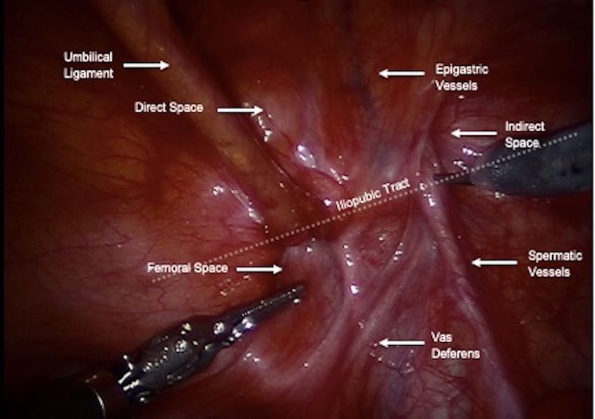 Ryan B. Cohen (@ryancohenmd) on Twitter photo Check out our case report in <a href="/BMJCaseReports/">BMJCaseReports</a> on staged robotic repair of de Garengeot hernia.
- laparoscopic appendectomy
- 4 days abxs
-🤖 hernia repair w/ mesh
<a href="/SurgeryEinstein/">EinsteinSurgery</a> <a href="/TeenaNerwal/">Teena Nerwal</a> #roboticsurgery #itsnotjustahernia
Link here: dx.doi.org/10.1136/bcr-20… Check out our case report in <a href="/BMJCaseReports/">BMJCaseReports</a> on staged robotic repair of de Garengeot hernia.
- laparoscopic appendectomy
- 4 days abxs
-🤖 hernia repair w/ mesh
<a href="/SurgeryEinstein/">EinsteinSurgery</a> <a href="/TeenaNerwal/">Teena Nerwal</a> #roboticsurgery #itsnotjustahernia
Link here: dx.doi.org/10.1136/bcr-20…