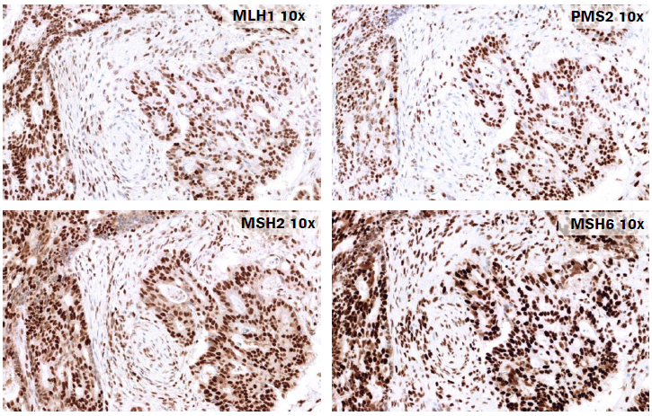 RocheDiaUSA's tweet photo. Welcome to this week's #TweetorialTuesday!
For August, we are focusing on the VENTANA MMR IHC Colorectal Carcinoma Panel (VENTANA MMR IHC CRC Panel).
#IHCPath #colorectalcarcinoma #mismatchrepair #chromosomalinstability #lynchsyndrome #brafv600emutation https://t.co/KSUV1KgpoT