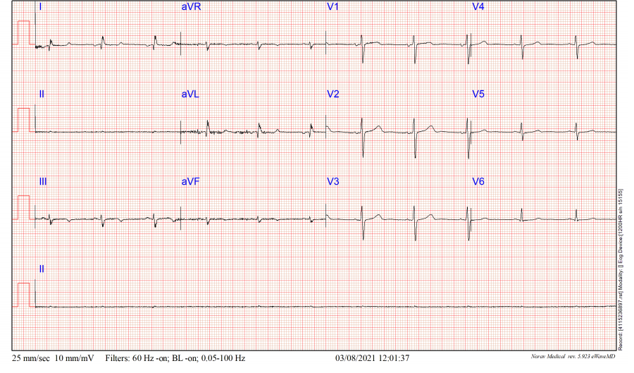syamkumarmd's tweet photo. #EPeeps, #Fellows ., Is there anything wrong in this ECG?
@GhaithAlmidani @bishoydf @MartowMartow @rudyunni @dog_oculus @adribaran @ecgrhythms @ECGfan @ECG_Emily @ecgoxford @UlhasDr @anunay_cardio @ELabartkava https://t.co/e6aFl0VXVX