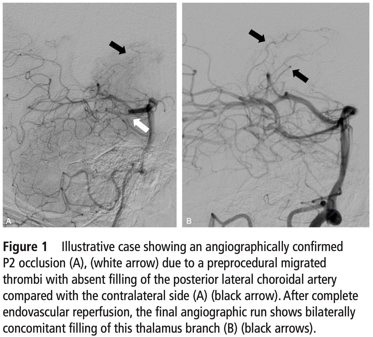 cvsection's tweet image. To treat or not to treat #DMVO? TOPMOST study group looks at 71 cases of distal P2 and P3 clots showing higher TICI 3 w/ more passes and periprocedural #clot migration - 38% first pass success
@JNIS_BMJ  @esmintsociety #strokeresearch #stroketwitter
ow.ly/XJDv50FHz4O