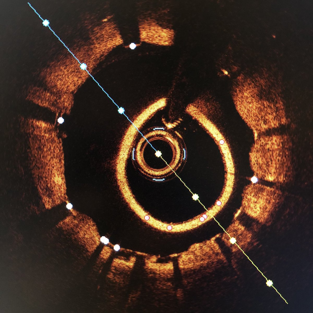Ostial coronary lesions not just for IVUS. Although OCT can’t see through guide catheters, it images beautifully through guide extenders (see bright circle below). Image while extender in coronary &amp; guide backed out into aorta #radialfirst