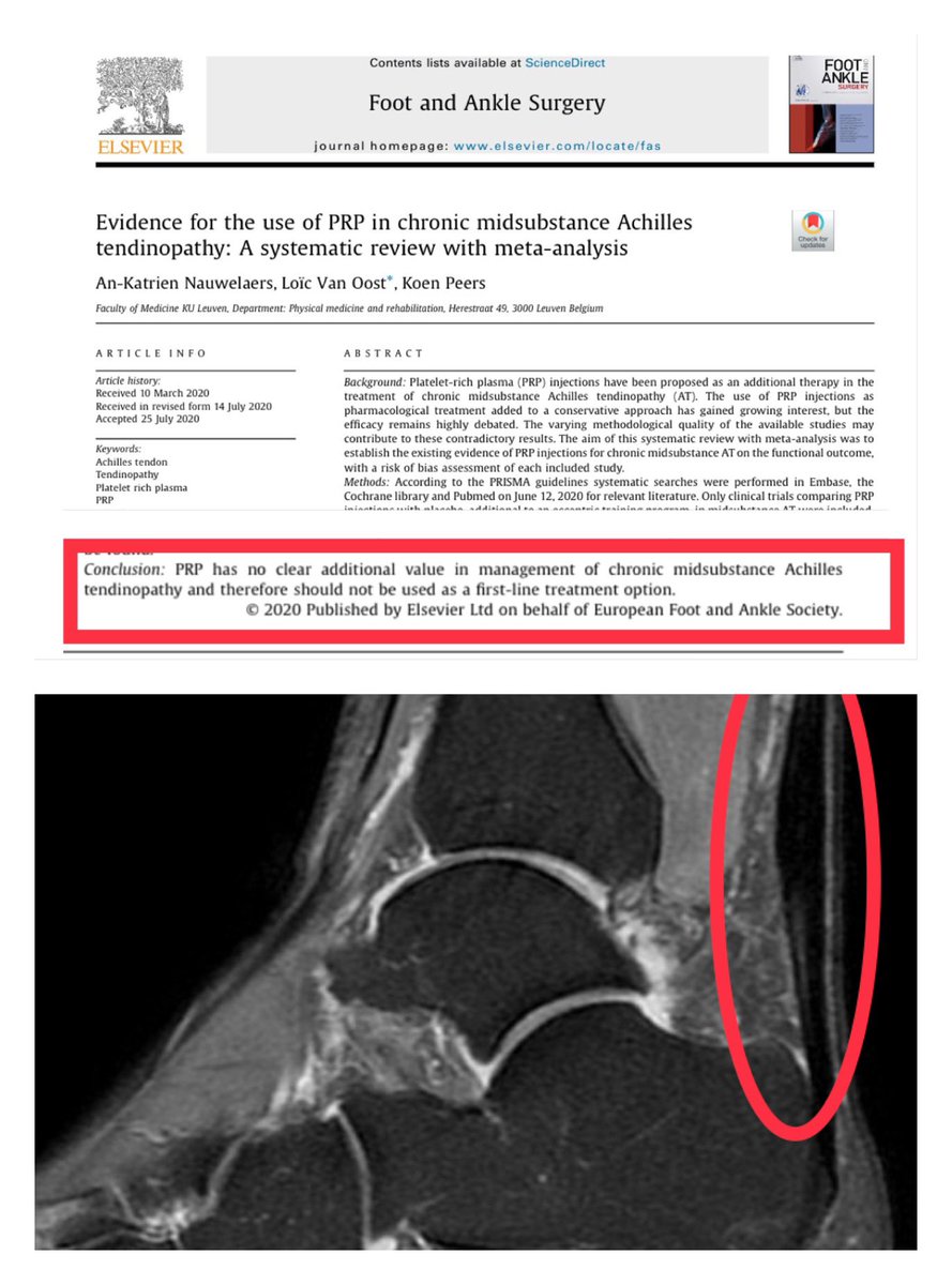 🔴EVIDENCE FOR THE USE OF PRP IN CHRONIC MIDSUBSTANCE ACHILLES TENDINOPATHY🔴

▪️PRP has no clear additional value in management in chronic midsubstance achilles tendinopathy and therefore shoud not be used as a first line treatment option