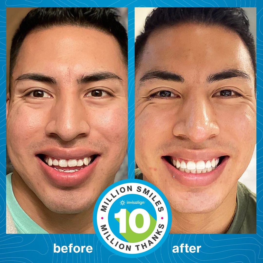Invisalign's tweet image. Over 10 million smiles and counting. 😀

📸: medina_rob

#invisalign #invisalignsmile #transformationtuesday