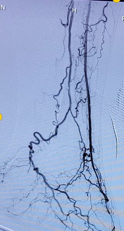 Yusuf Karavelioğlu (@dryusufkaraveli) on Twitter photo Case of the day.Deformed distal SFA stent + instent 100%. popliteal and ATA total. We could not pass the stent intraluminal (antegrade + retrograde+ EVUS)we crushed the stent and implanted new one.We were able to find such a solution.what would you do?<a href="/ErsaTatl/">Prof.Dr. Ersan Tatlı</a> <a href="/LorenzoPatrone3/">Lorenzo Patrone</a> Case of the day.Deformed distal SFA stent + instent 100%. popliteal and ATA total. We could not pass the stent intraluminal (antegrade + retrograde+ EVUS)we crushed the stent and implanted new one.We were able to find such a solution.what would you do?<a href="/ErsaTatl/">Prof.Dr. Ersan Tatlı</a> <a href="/LorenzoPatrone3/">Lorenzo Patrone</a>
