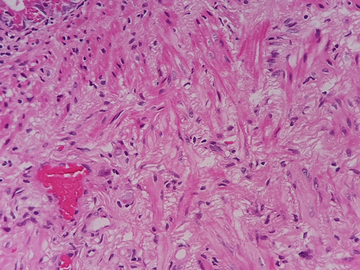 @medannabel @joaquinnieves55 @Prietinho @nucleololailo Deeper levels... Gone 😶. The clinician ordered an endosonography.