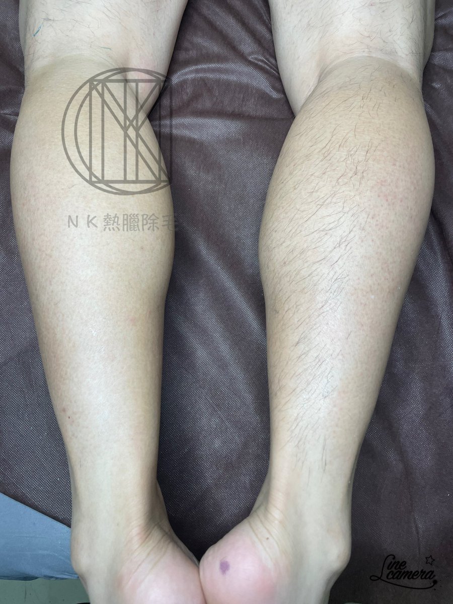 Nick男士熱臘除毛
除毛師NICK
⭐️完全預約
📱諮詢預約Line:lin.ee/7R6AyiL

#男士熱臘除毛#熱臘除毛#巴西式除毛＃無毛＃除毛＃男性除毛