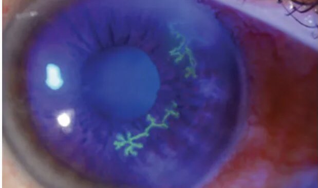 #IdBoardReview a patient presents w/ acute onset of 👁 pain, visual blurring, photophobia, watery ocular discharge & red eye. Dx? #medEd #idmedEd #IDtwitter