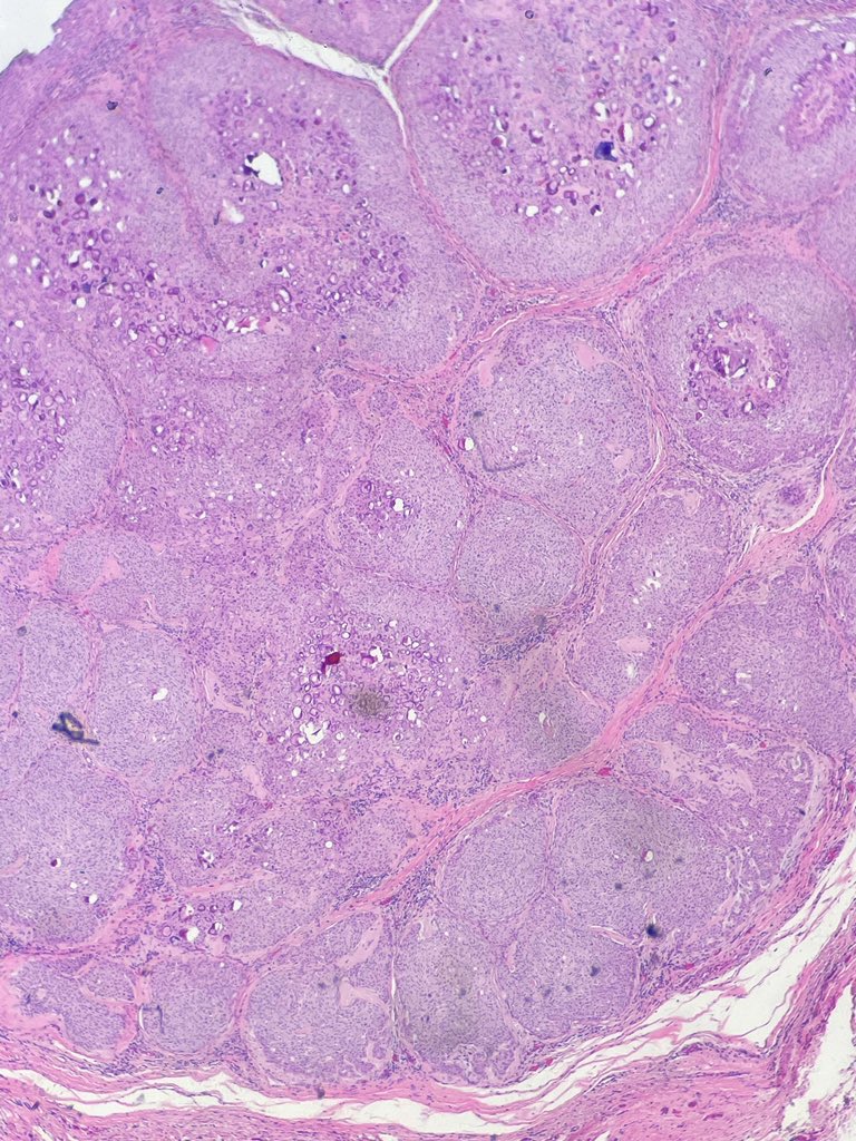 dojaomer's tweet photo. Peripheral lesion with RL in mandible?
#HNpath #ENTpath #Opath #oralpath https://t.co/U73tYZB17f
