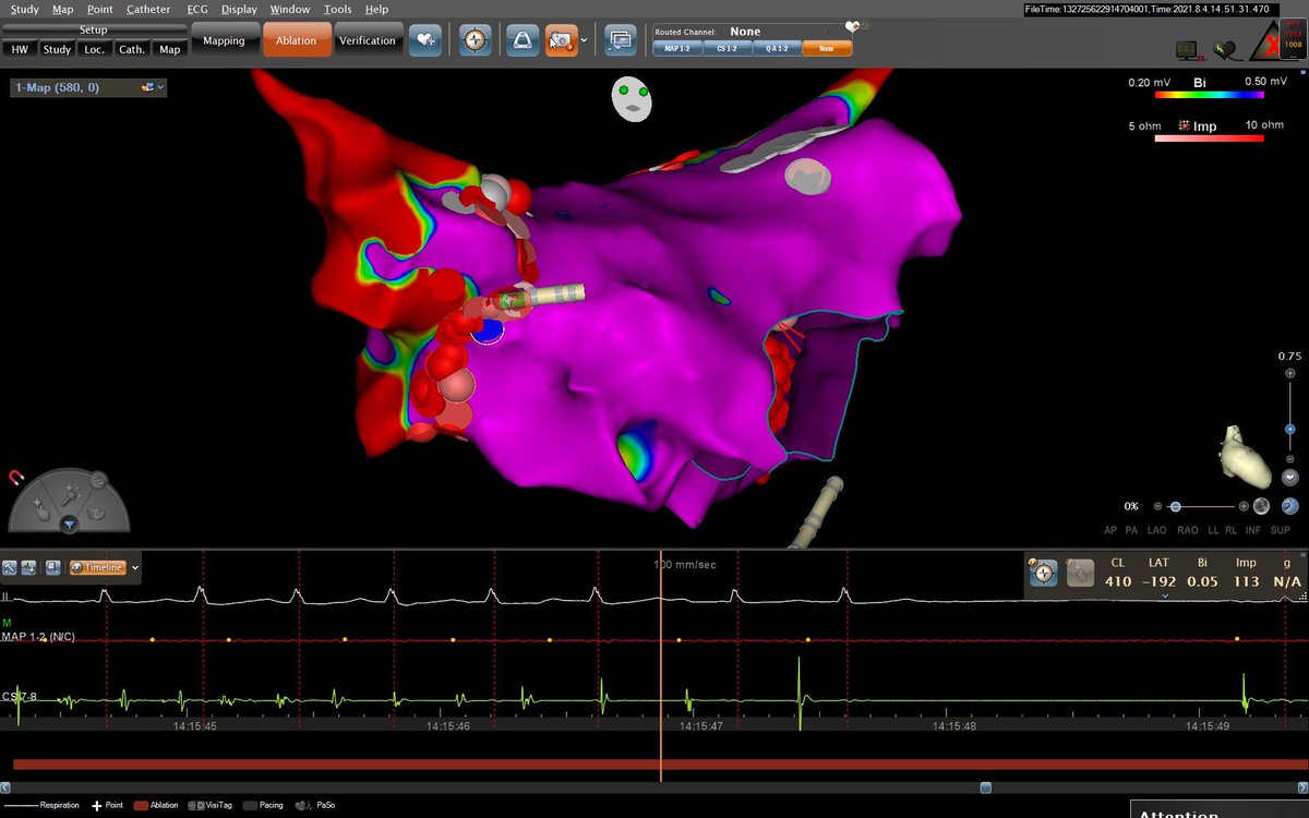 Tolga Aksu, MD (@mdtolgaaksu) on Twitter photo It is always great to see that. The case was done with our new EP fellow <a href="/MeltemAltnsoy/">ScarelatedVT</a> <a href="/DursunAras2/">Dursun Aras, Professor</a> <a href="/drtopaloglu/">Prof. Dr. Serkan Topaloğlu</a> <a href="/prof_serkan_cay/">Prof Dr Serkan Cay</a> <a href="/ozcanozeke/">Özcan Özeke</a> <a href="/HappyEP/">Emin Evren Özcan</a> <a href="/taylanakgun/">Taylan Akgün</a> @drerkanbaysal @U_Cnplt <a href="/can_yontar/">𝐂𝐚𝐧 𝐘𝐨𝐧𝐭𝐚𝐫</a> It is always great to see that. The case was done with our new EP fellow <a href="/MeltemAltnsoy/">ScarelatedVT</a> <a href="/DursunAras2/">Dursun Aras, Professor</a> <a href="/drtopaloglu/">Prof. Dr. Serkan Topaloğlu</a> <a href="/prof_serkan_cay/">Prof Dr Serkan Cay</a> <a href="/ozcanozeke/">Özcan Özeke</a> <a href="/HappyEP/">Emin Evren Özcan</a> <a href="/taylanakgun/">Taylan Akgün</a> @drerkanbaysal @U_Cnplt <a href="/can_yontar/">𝐂𝐚𝐧 𝐘𝐨𝐧𝐭𝐚𝐫</a>