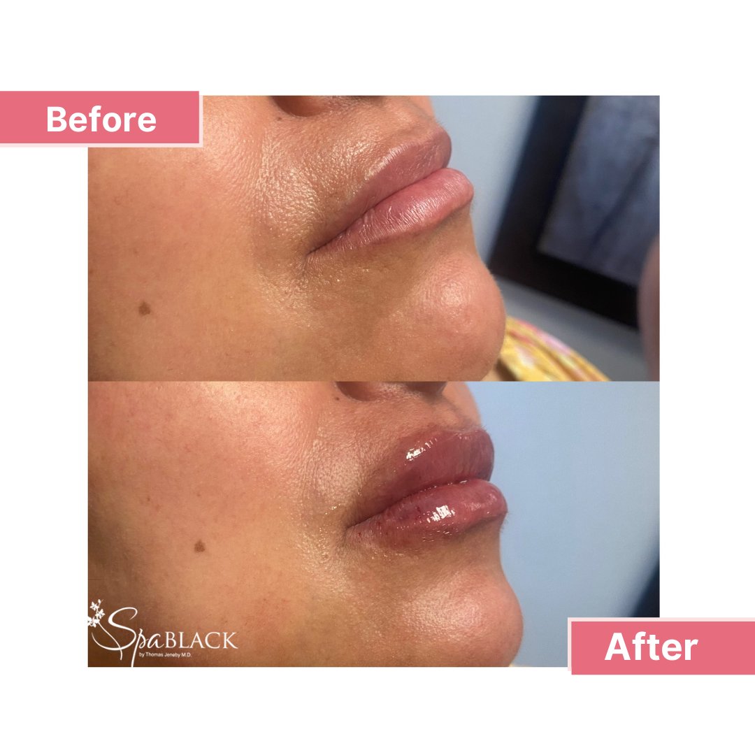 spablackmedspa's tweet photo. So beautifully done 💋 
..
Lips by: Rebekah 💉 
Product Used: Versa** https://t.co/myJz2yWoVx