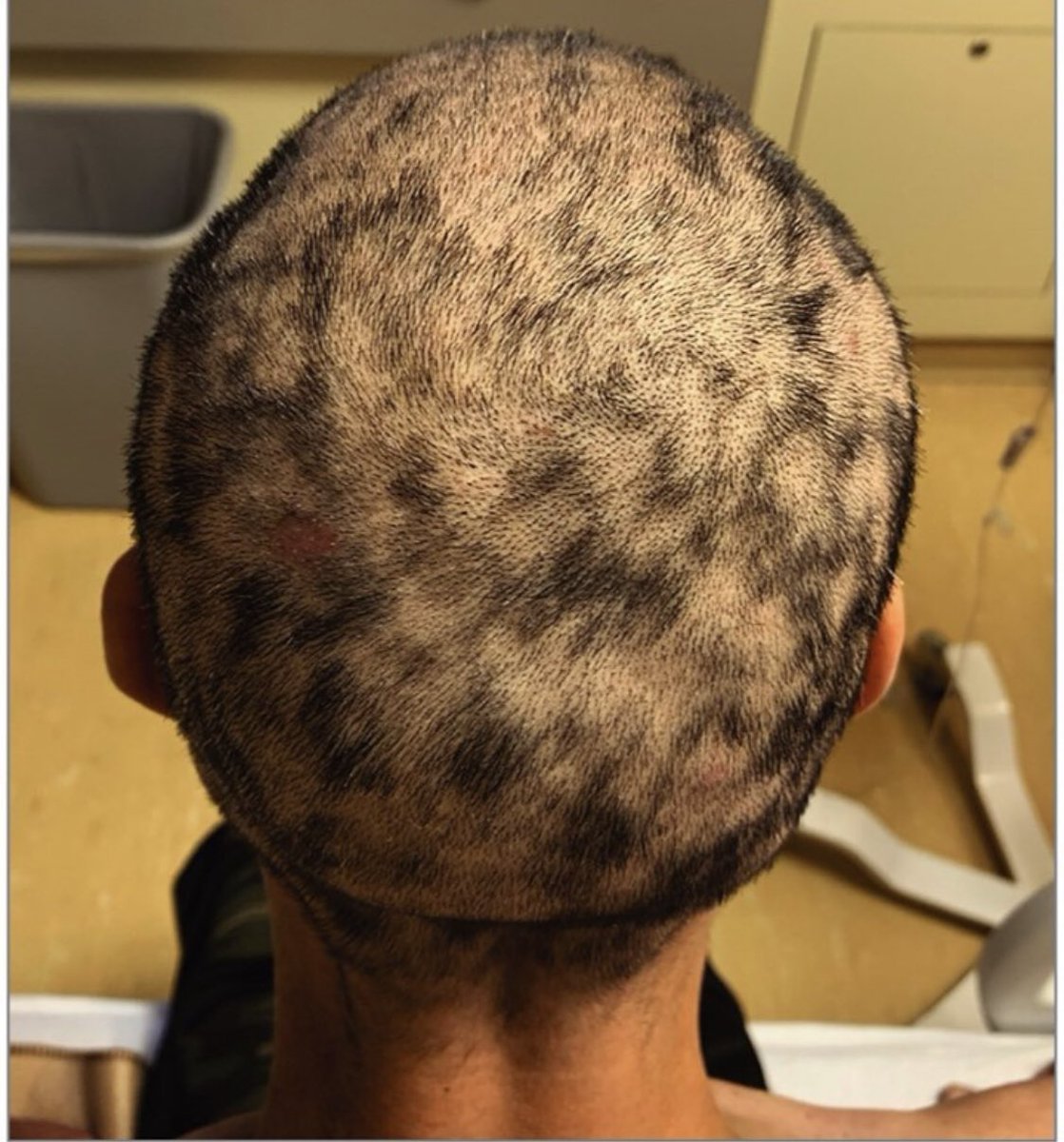 andresmtbr's tweet photo. Mujer de 36 años de edad, VIH positiva y antecedentes de alcohol y tabaco, se presenta por pérdida de cabello en parches. 
Sifilis secundaria, puede causar alopecia y confundir el diagnóstico con alopecia areata, en clínica e histopatologia 
JAMA. 2021;326(5):435-436. https://t.co/FYPgaykrM2