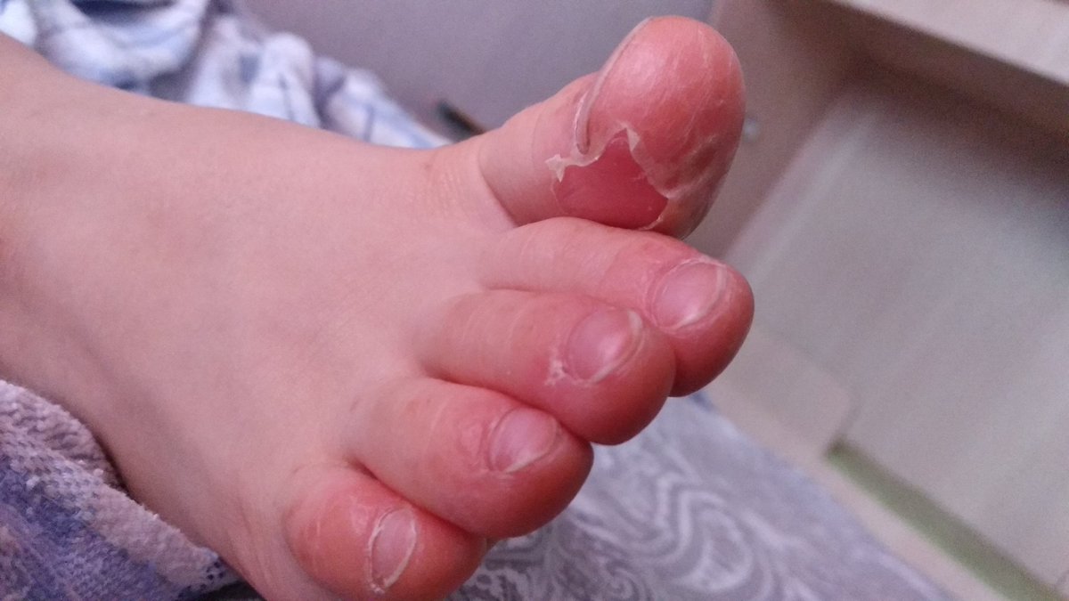 У нас власти города круглосуточно борятся с ковидом даже даже колят 24часа в сутки, но не кто не в бьёт в барабаны что по детским садам гуляет вирус Коксаки согласен не смертельный но как при этом дети мучаются и температура и облезают и тишина не кто это проблему не видит