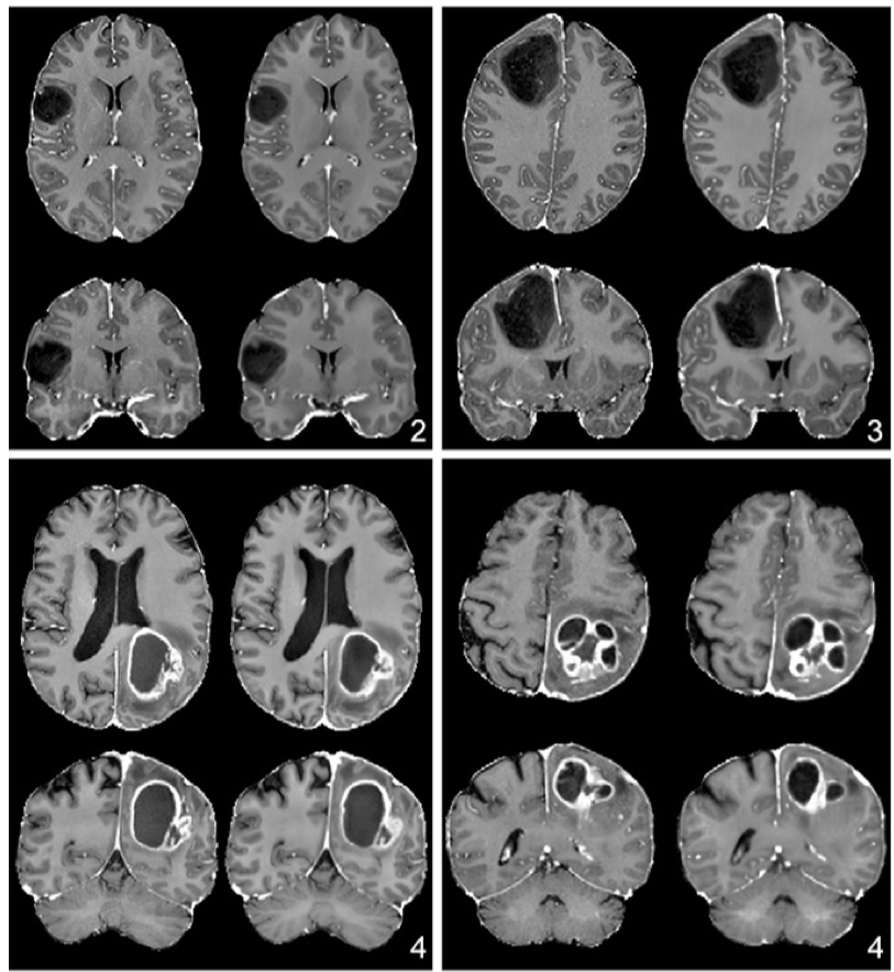 DrDreMDPhD's tweet photo. Can you tell which is real and which is simulated? (I couldn't.) Hot off the press (@Radiology_AI), using a CNN to simulate post-contrast images of gliomas using other MRI sequences, great work by @ecalabr @UCSFimaging @UCSF_Ci2 @RadRudie. https://t.co/CVNKCottf5