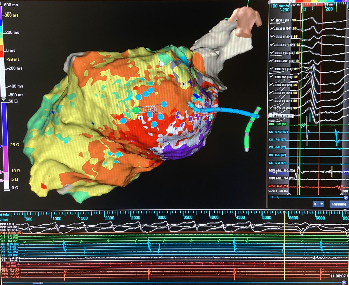texasEPkait's tweet photo. TGIF! Redo non-ischemic VT on an LVAD patient this morning. Concentrated LPs in sinus 👉🏻complex fractionation in VT👉🏻mid-diastolic on ablation👉🏻one burn term leaving this pt non-inducible! Mapped by @PraveenRao_EP with #hdgrid by @AbbottCardio #ablatevt #epeeps #oneburnterm https://t.co/T1iKC0b5Gu