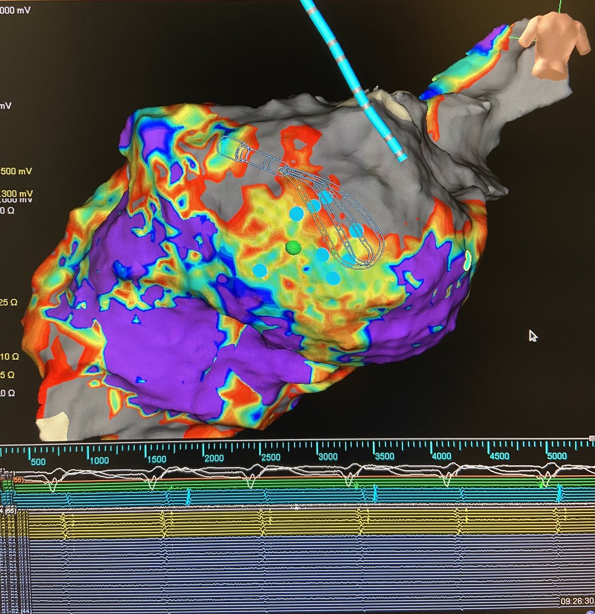 texasEPkait's tweet photo. TGIF! Redo non-ischemic VT on an LVAD patient this morning. Concentrated LPs in sinus 👉🏻complex fractionation in VT👉🏻mid-diastolic on ablation👉🏻one burn term leaving this pt non-inducible! Mapped by @PraveenRao_EP with #hdgrid by @AbbottCardio #ablatevt #epeeps #oneburnterm https://t.co/T1iKC0b5Gu