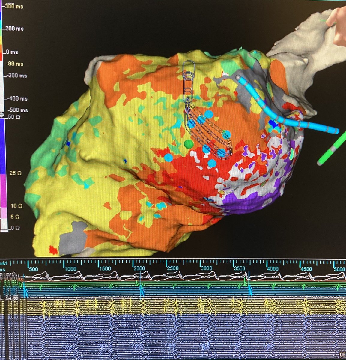 texasEPkait's tweet photo. TGIF! Redo non-ischemic VT on an LVAD patient this morning. Concentrated LPs in sinus 👉🏻complex fractionation in VT👉🏻mid-diastolic on ablation👉🏻one burn term leaving this pt non-inducible! Mapped by @PraveenRao_EP with #hdgrid by @AbbottCardio #ablatevt #epeeps #oneburnterm https://t.co/T1iKC0b5Gu