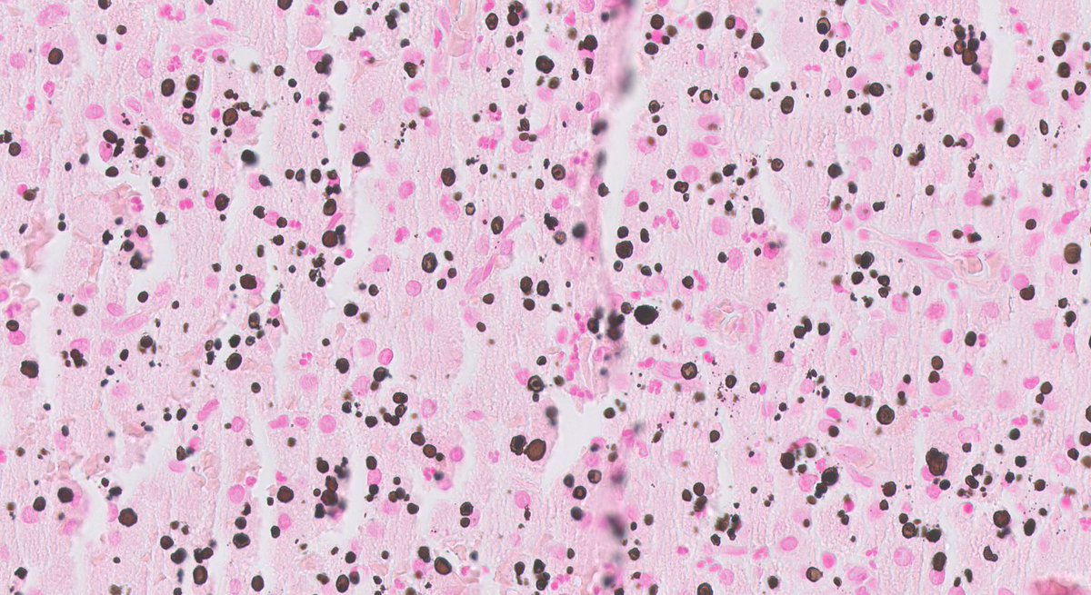 mhassanaimc's tweet photo. - Malakoplakia (von Hansemann cells) in an older woman presenting as a bladder mass
- Eosinophilic cytoplasm and round nuclei
- Distinct, targetoid intracytoplasmic inclusions (Michaelis-Guttman bodies) are prominent in this case
- Von Kossa stain confirms that #GUpath https://t.co/rkBisHlp4A