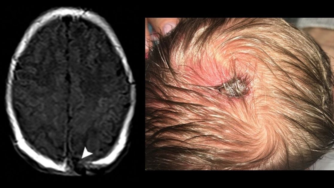 Calvarial lesions commonly present a diagnostic challenge. This article describes an imaging feature-based systematic approach to abnormalities of the calvarium with comprehensive illustrative examples. bit.ly/3kmERB1