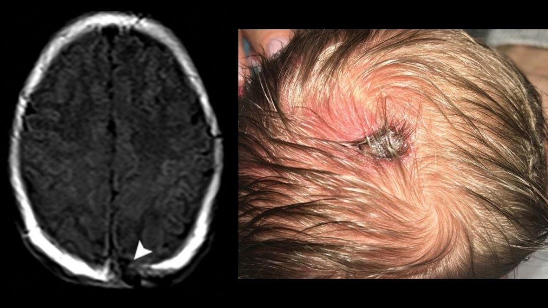 RadioGraphics (@radiographics) on Twitter photo Calvarial lesions commonly present a diagnostic challenge. This article describes an imaging feature-based systematic approach to abnormalities of the calvarium with comprehensive illustrative examples. bit.ly/3kmERB1 Calvarial lesions commonly present a diagnostic challenge. This article describes an imaging feature-based systematic approach to abnormalities of the calvarium with comprehensive illustrative examples. bit.ly/3kmERB1