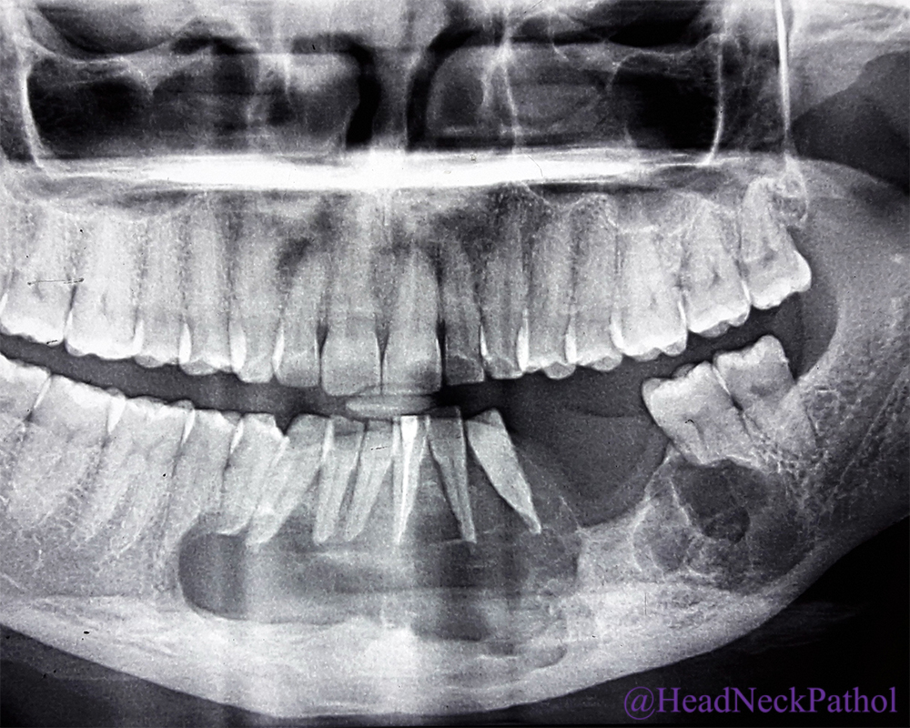 Ameloblastoma X Ray