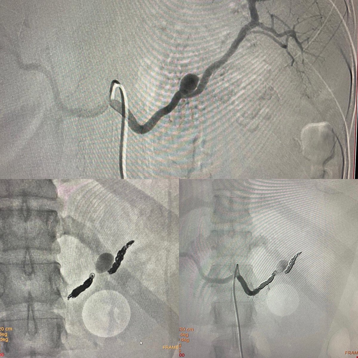 Leonardo Cortizo, MD (@leocortizo1) on Twitter photo Chronic pancreatic pseudocyst associated with esplenic artery pseudoaneurysm is often complicated by severe hemorrhage. Case treated with coil embolization by trapping technique <a href="/paulomenezesf/">Paulo Menezes Filho</a> @bdsmc <a href="/andrebrq/">André Brito Queiroz</a> #pseudoaneurysm #pseudocyst #embolization #esplenic Chronic pancreatic pseudocyst associated with esplenic artery pseudoaneurysm is often complicated by severe hemorrhage. Case treated with coil embolization by trapping technique <a href="/paulomenezesf/">Paulo Menezes Filho</a> @bdsmc <a href="/andrebrq/">André Brito Queiroz</a> #pseudoaneurysm #pseudocyst #embolization #esplenic