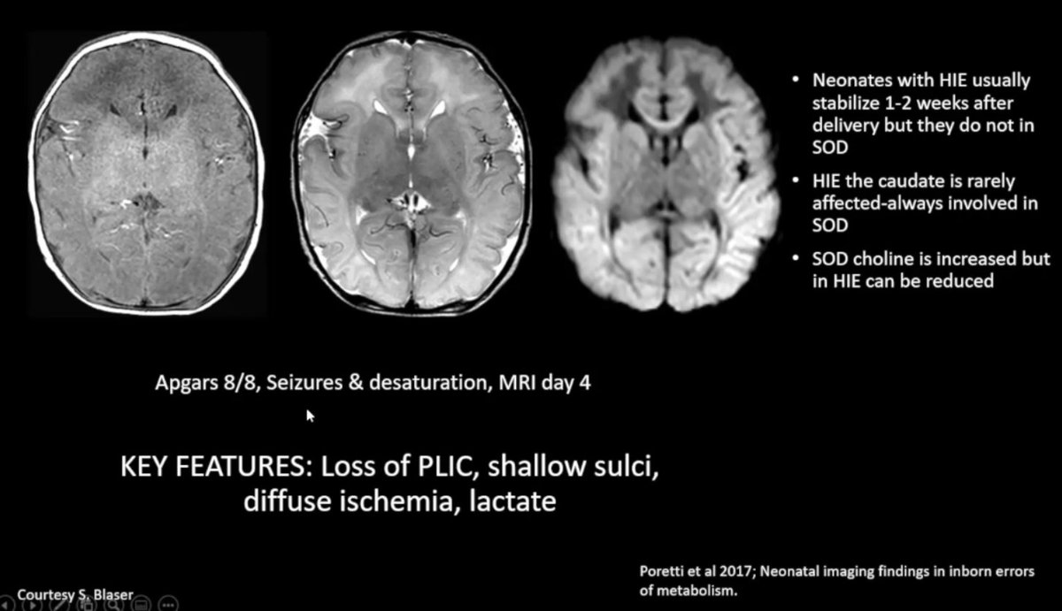 Comprehensive review of HIE mimics by Dr Helen Branson at #SPIN2021 

- Most HIE have a history of intrapartum issues and present very soon after birth.

- Normal Apgars and delivery: think metabolic, stroke, infection, genetics but consider antental HIE with partial recovery.