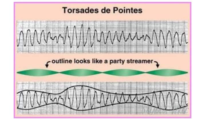 pgMedicine's tweet photo. Torsades de pointes
(Twisting of the points)
🔴Treatment:
⚫Stop all drugs which causes prolong QT
⚫Correct any electrolyte abnormalities
⚫IV #MgSo4
🟢If above treatment failed than temporary pacemaker
#CardioTwitter #MedTwitter #ecg #ekg #foamed #MedEd https://t.co/m0detJonDK
