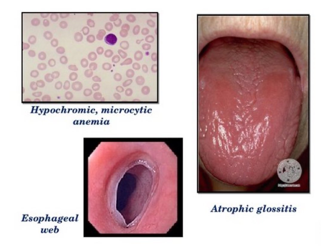 Atrophic Glossitis Iron Deficiency Anemia