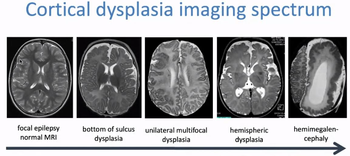 Prof. Rick Leventer @MCRI_for_kids delivers an inspiring and thought provoking keynote at #SPIN2021. 'Dysgyria needs to be clarified and explored further- some approaches'; 'First step in classifying Polymicrogyria can be based on head size'; 'Cortical dysplasia has many faces!'