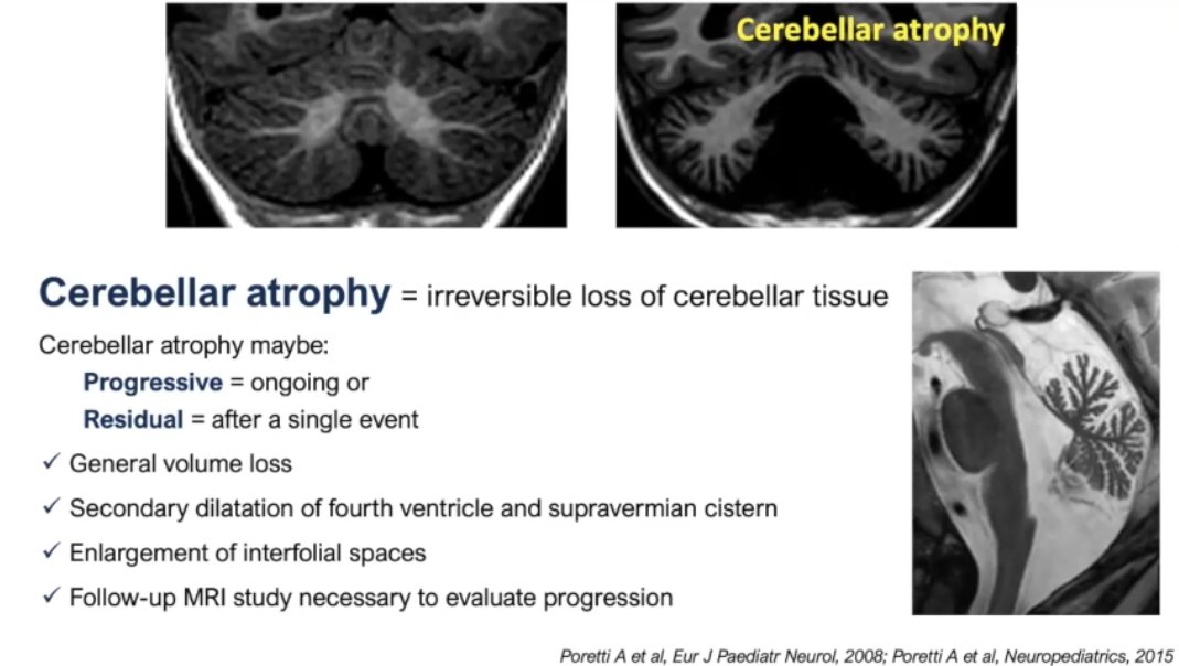 Lucid talk on cerebellar atrophy from @MSavinaSeverino at #SPIN2021 Neuroimaging based pattern-recognition of paediatric CA may permit correct diagnosis, targeted investigations, interpretation of lab results, and reverse phenotyping #pedineurorad