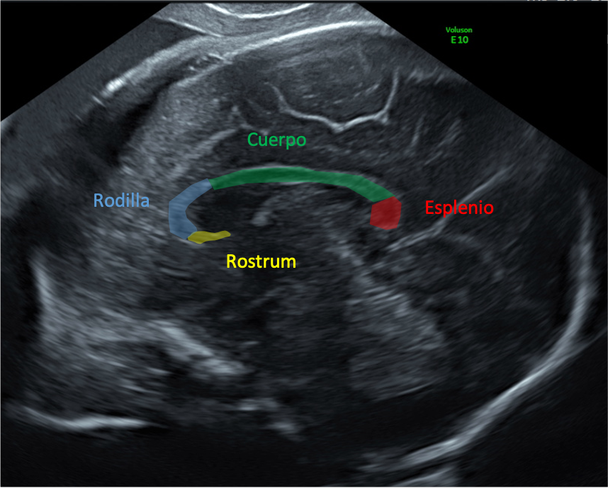 medfetalBCN's tweet photo. Sabes que los fetos con cardiopatía congénita presentan un Cuerpo Calloso más pequeño? El tamaño del CC podría ser un marcador clínico útil para valorar el desarrollo de la sustancia blanca en malformaciones del corazón según @BCNatalResearch. En @ISUOG 

https://t.co/y5kBdvkvlb https://t.co/ku2FtNGSRl