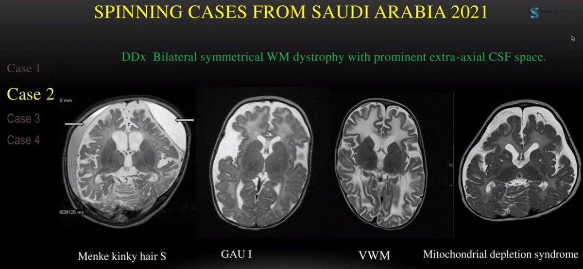 Instructive teaching cases from Saudi Arabia at #SPIN2021 presented by @AmnaKashgari.Bilateral white matter signal changes with prominent extra-axial CSF spaces have a clear cut differential. Use these in your reports to add value! For more, register @spinacademics for catch up!