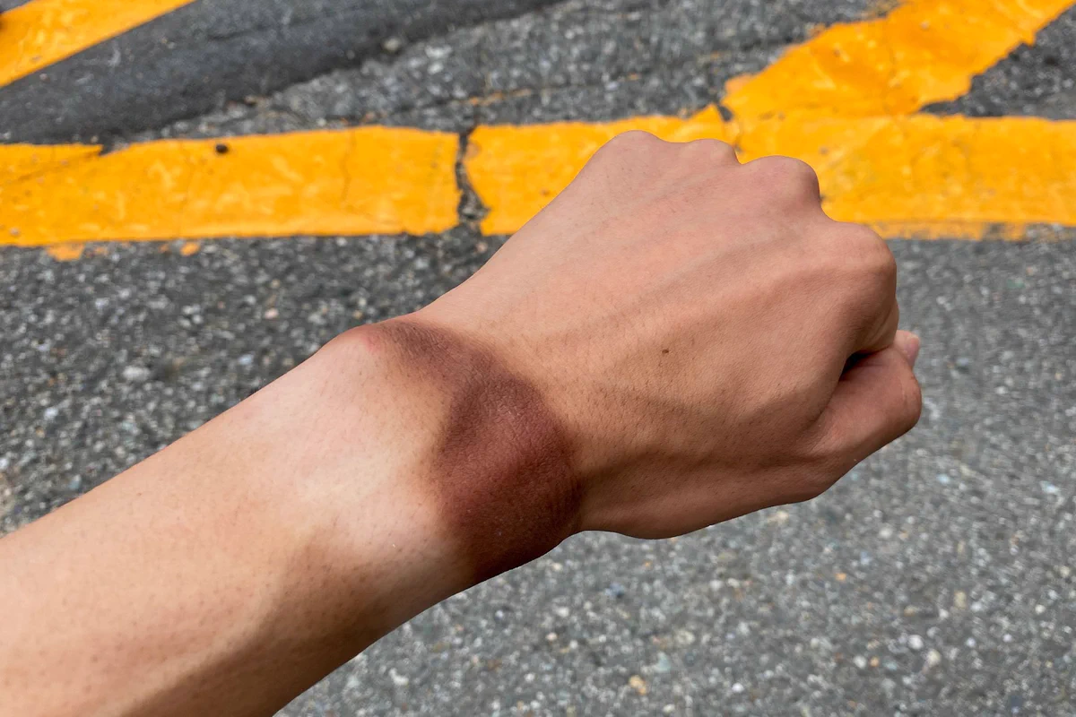 日焼けの跡がすごい･･･！登山の際しっかり日焼け対策をすることの大切さがよく分かるツイートが話題に！