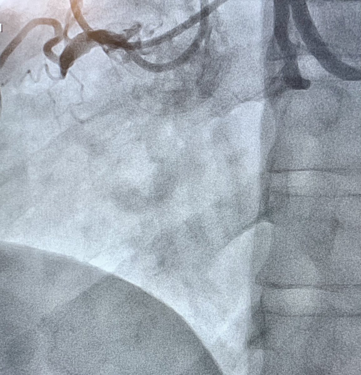 ReVascMed's tweet image. Tale of 2 CTOs: dual simultaneous coronary injections, wire escalation, and antegrade dissection re-entry for successful revascularization. #hybridalgorithm @jcgeorgemd @GPAngioClub @ACVCPhila @PennCardiology @PennCVFellows