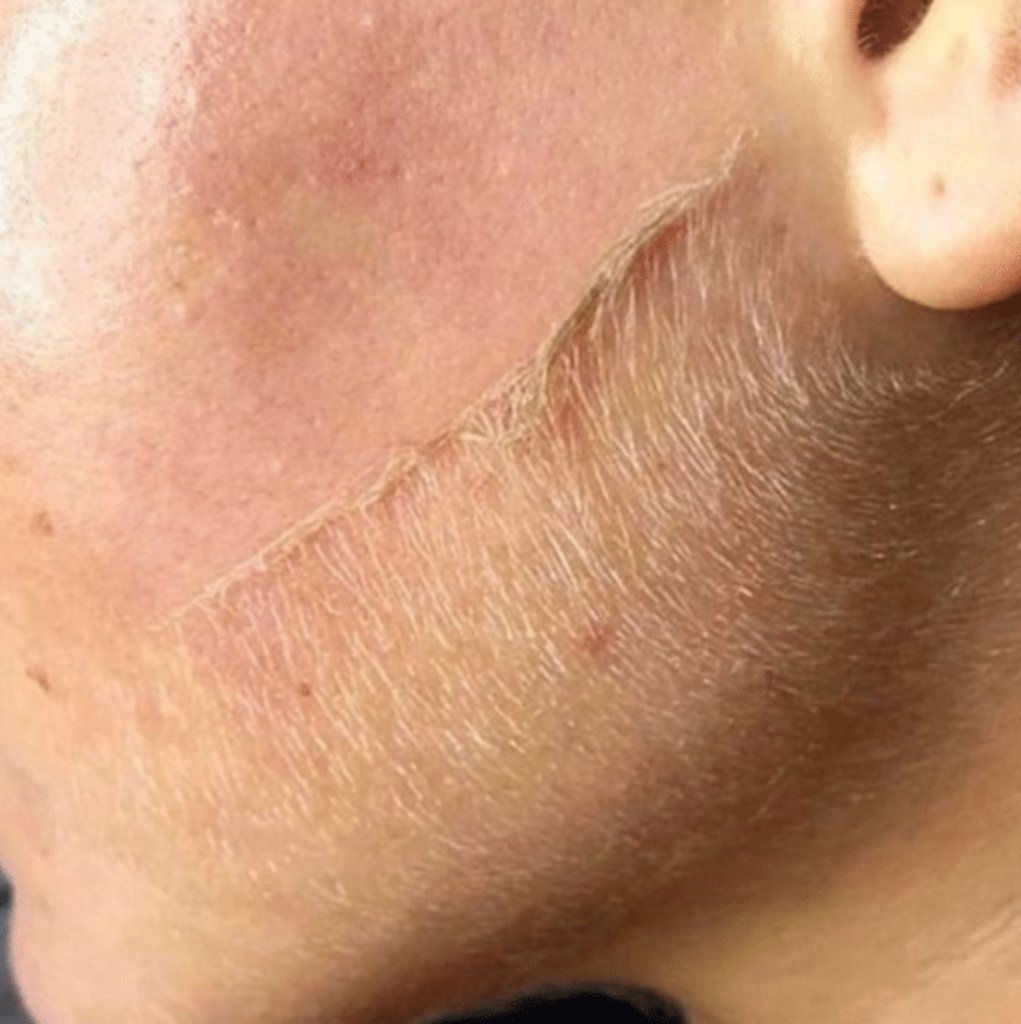 MD_Spa's tweet image. Check out that afterglow!
Call now and book with our "new to MD Spa" esthetician and save! All dermalplaning treatments with Janine are $79 for a limited time!

#yeg #botox #beauty #skincare #medspa #juvederm #vivier #fillers #organic #thermage #acne #eminence #skin