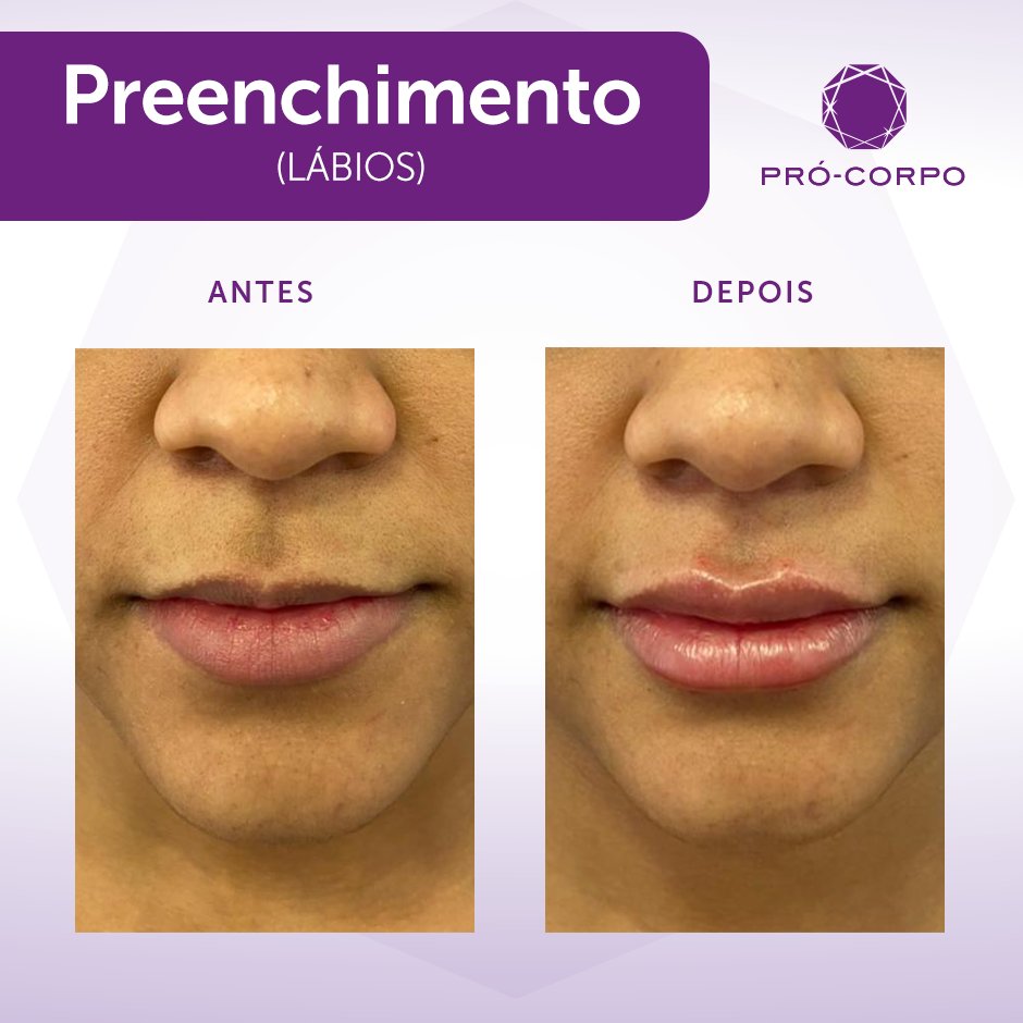 ProCorpo's tweet image. O Preenchimento Labial traz uma combinação incrível de contorno+volume de uma forma super natural!👄

E você tem vontade de fazer preenchimento?🤩

#preenchimento #preenchimentolabial #acidohialuronico #labios #selfcare #beleza #estetica #procorpoestetica