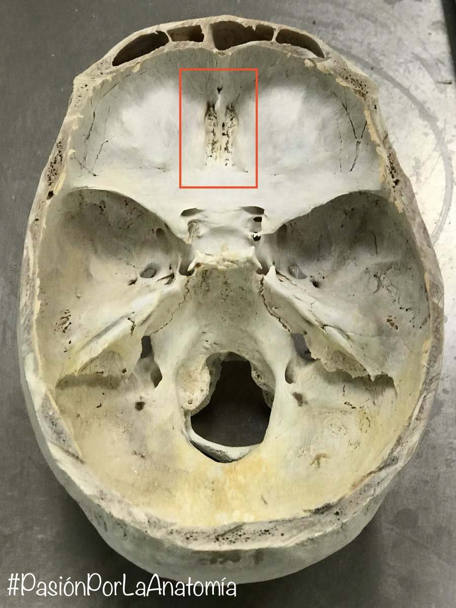 PasionAnatomia's tweet photo. La #LáminaCribosa del hueso #etmoides forma el límite óseo entre la cavidad nasal y la #FosaCranealAnterior. A través de sus orificios pasan los filetes olfatorios del #NervioOlfatorio (I) https://t.co/X95lXi674I