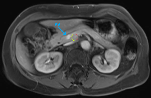 Laparoscopic resection of functioning PNET (red) at the uncinate process between the PV (blue) and SMA. Combined cephalad and caudal approach to uncinate to define transection line (yellow) #SoMe4Surgery