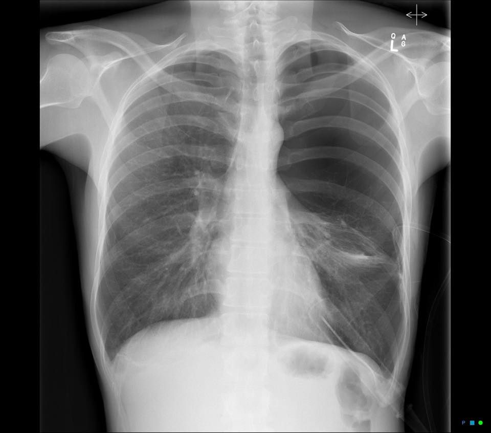 Q: 35yo male with ICC inserted for pneumothorax... or is it? 🤔 ANSWER: bit.ly/37cygPh #FOAMrad #FOAMed