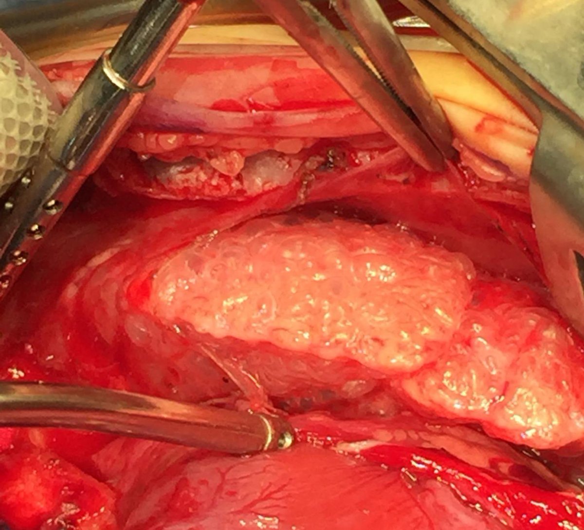 Neonatal pulmonary interstitial emphysema 😳

You know what PIH looks like on XR but this is how it actually looks when you open the chest.

#LOOK at the bubbles on the surface of the lung …. 🫁

#medtwitter #neotwitter #tweetiatrician #pedsICU #pediatrics