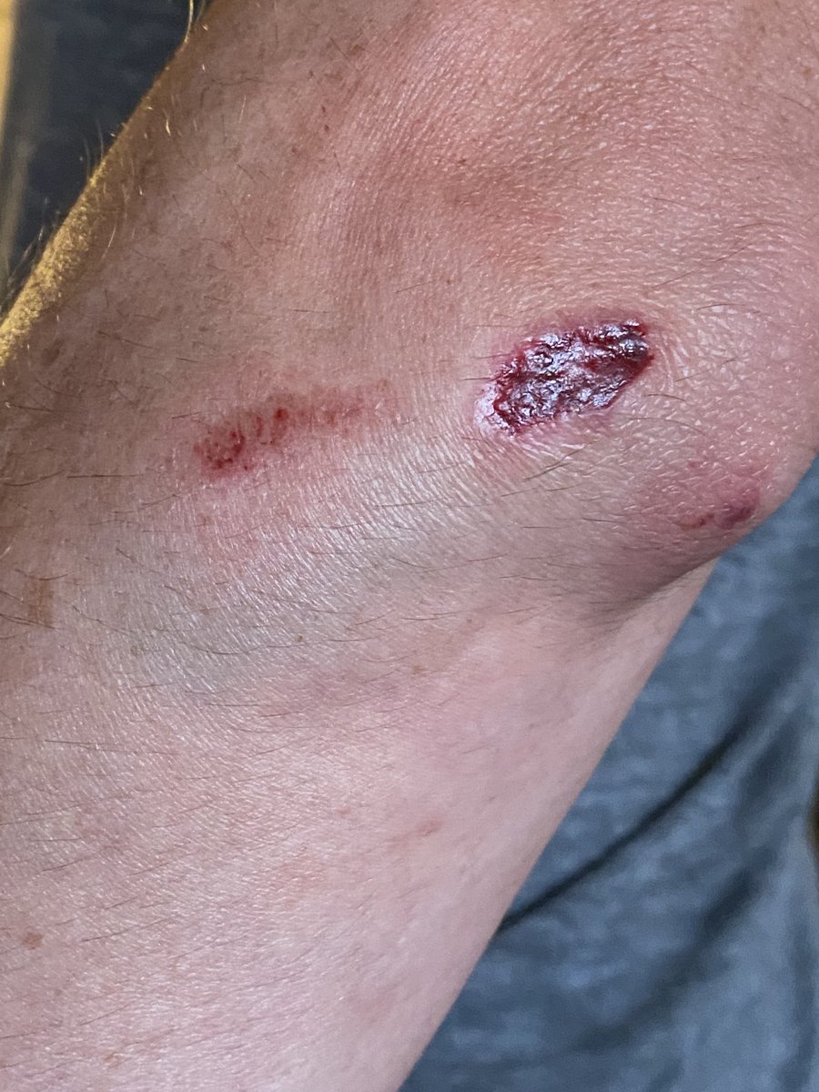 raeholtsbaum's tweet photo. Hey @CityofRegina I just had a bad spill on my run when I tripped on this badly broken sidewalk @ 960 Assiniboine Ave E. Can you fix it please? https://t.co/5imEe1qpVJ