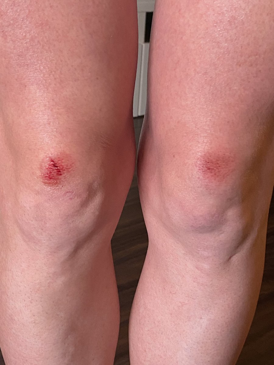 raeholtsbaum's tweet photo. Hey @CityofRegina I just had a bad spill on my run when I tripped on this badly broken sidewalk @ 960 Assiniboine Ave E. Can you fix it please? https://t.co/5imEe1qpVJ