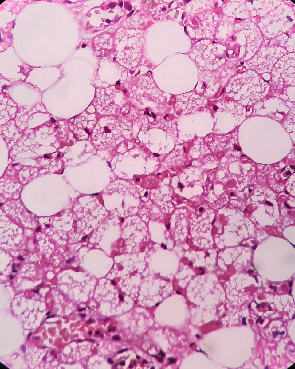 tumashankar's tweet photo. 16yF PCT. Neck nodes. Anush👍
@archibhat3 @VijayPath1p @lovelygeorge10 @Swathiprabhu5 @DrVasudevPrabhu @vi_monappa  @padmapathology1 @glinglerimek @Divya_Madhala @DrGeeONE  @kriyer68 @Vik_deshpandeMD @Histopatolomon @TristanRutland7 @pepeheffernan #thyroid #PathTwitter https://t.co/36LXXk3jlC