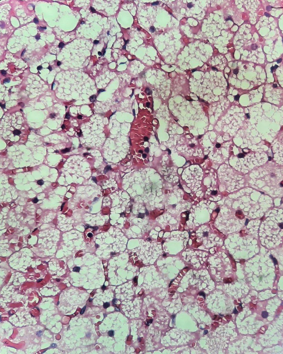 tumashankar's tweet photo. 16yF PCT. Neck nodes. Anush👍
@archibhat3 @VijayPath1p @lovelygeorge10 @Swathiprabhu5 @DrVasudevPrabhu @vi_monappa  @padmapathology1 @glinglerimek @Divya_Madhala @DrGeeONE  @kriyer68 @Vik_deshpandeMD @Histopatolomon @TristanRutland7 @pepeheffernan #thyroid #PathTwitter https://t.co/36LXXk3jlC
